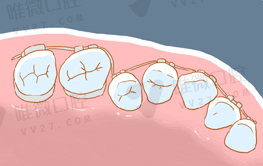 活动义齿优点和缺点（单颗活动牙的好处和坏处）(图1)